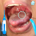 Pickout oral foreign body remover throat poop removal method inhaler blue, 1 piece