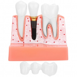 Dantų modelis Dantų implantų analizė Karūnos tilto modelio demonstracinis danties modelis