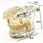 1 vnt. Dantų implantų ligos dantų modelis su restauracija, tiltu, dantis odontologui medicinos mokslui, dantų ligų mokymui, studijoms 1 piece clear